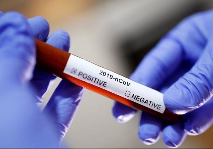 Azərbaycanda koronavirusa 33 yeni yoluxma qeydə alınıb, 23 nəfər sağalıb, bir nəfər vəfat edib